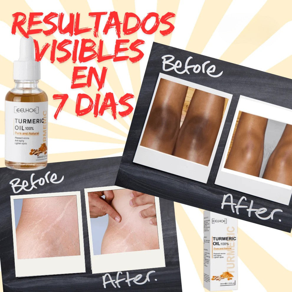 1+1 GRATIS | Aceite Esencial de Cúrcuma™ (EELHOE)