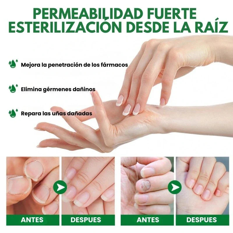 7 Days Fungus Free Nails® - Protege y elimina el hongo de tus Uñas