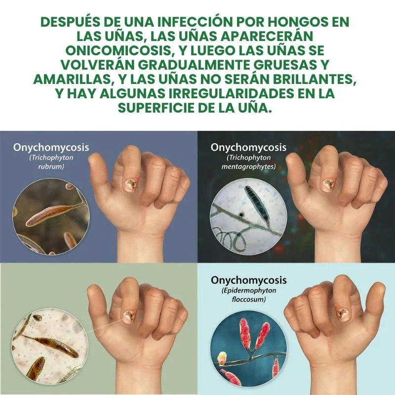 7 Days Fungus Free Nails® - Protege y elimina el hongo de tus Uñas