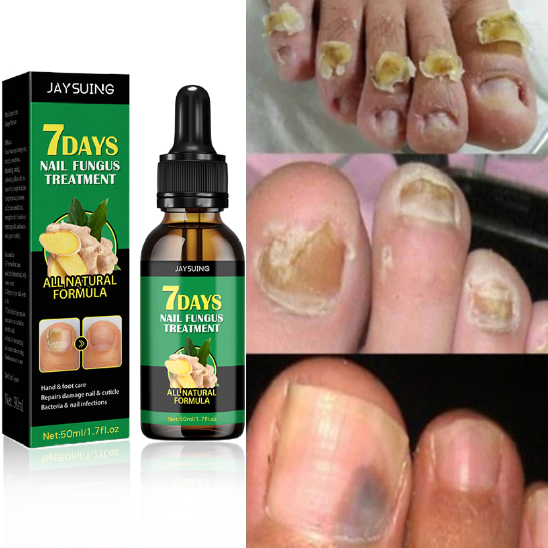 7 Days Fungus Free Nails® - Protege y elimina el hongo de tus Uñas